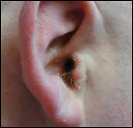 Dry Skin on the Ear Canal
